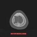 Nasopharyngeal carcinoma recurrence - skull base destruction (Radiopaedia 29107-29490 Axial bone window 8).jpg