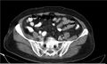 Necrotizing pancreatitis (Radiopaedia 20595-20495 A 34).jpg