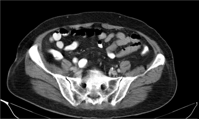 File:Necrotizing pancreatitis (Radiopaedia 20595-20495 A 34).jpg
