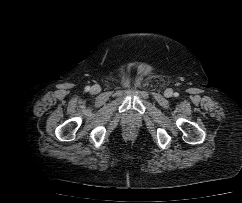 Nephroptosis with inguinal hernia containing perirenal fat (Radiopaedia 56632-63391 C 334).jpg