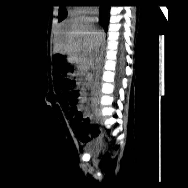 File:Neuroblastoma with skull metastases (Radiopaedia 30326-30960 B 23).jpg