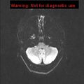 Neuroglial cyst (Radiopaedia 10713-11184 Axial DWI 41).jpg