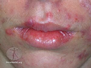 Nodulocystic acne conglobata with SAPHO syndrome. (DermNet NZ acne-089-v2).jpg