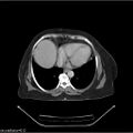 Non-Hodgkin lymphoma (Radiopaedia 27492-27690 B 32).jpg