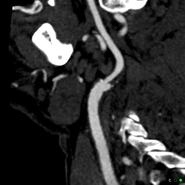 File:Non-occlusive intraluminal internal carotid artery thrombus (Radiopaedia 37751-39658 C 53).jpg