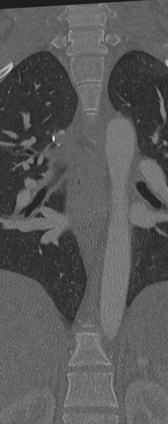 File:Normal CT thoracic spine (Radiopaedia 40181-42688 Coronal bone window 23).png