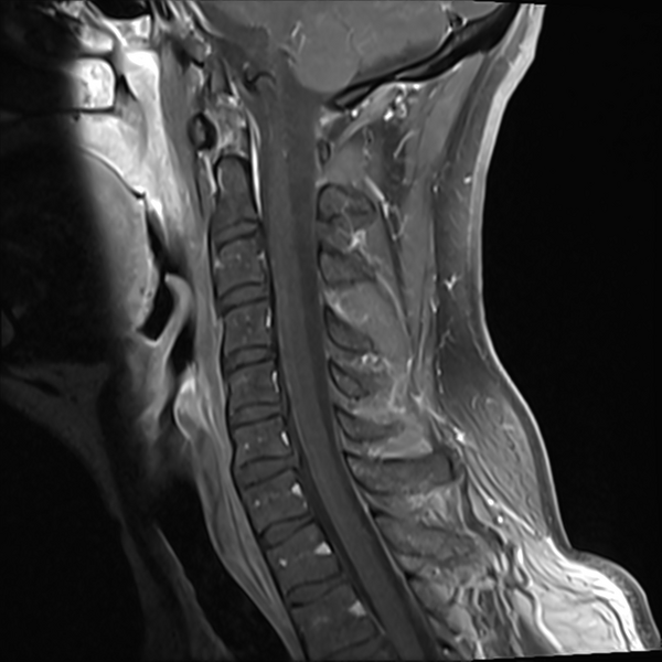 File:Normal MRI cervical spine (infection protocol) (Radiopaedia 53916-60039 I 6).png