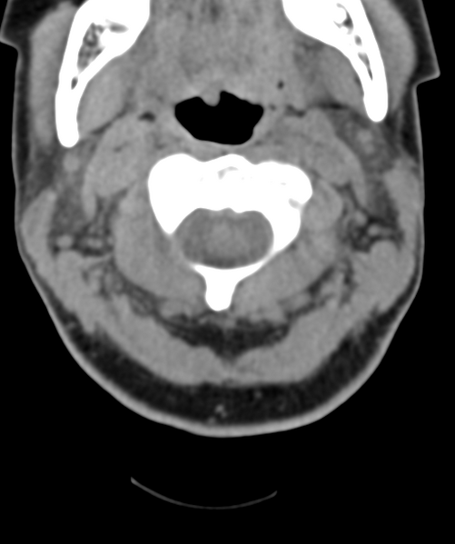 File:Normal cervical spine MRI (including Dixon) (Radiopaedia 42762-45926 Axial non-contrast 16).png