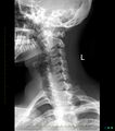 Normal cervical spine radiographs (Radiopaedia 32505-33464 D 1).jpg