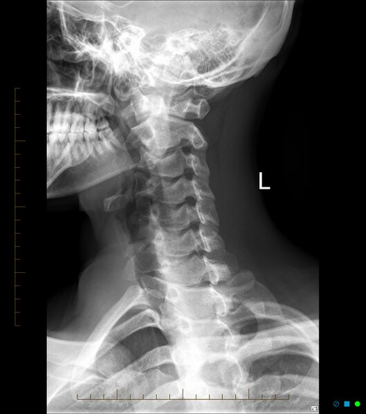 File:Normal cervical spine radiographs (Radiopaedia 32505-33464 D 1).jpg
