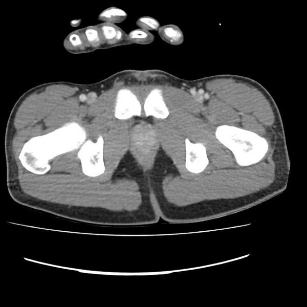 File:Normal dual-phase trauma CT chest,abdomen and pelvis (Radiopaedia 48092-52899 A 115).jpg