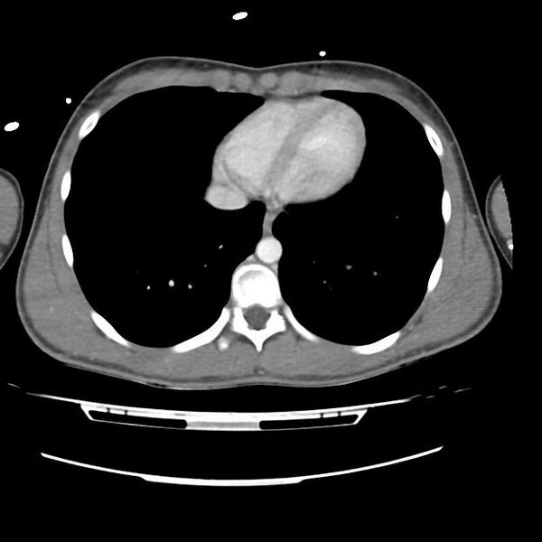 File:Normal dual-phase trauma CT chest,abdomen and pelvis (Radiopaedia 48092-52899 A 40).jpg