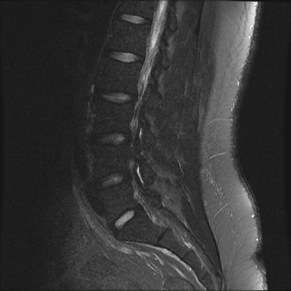 File:Normal lumbar spine MRI (Radiopaedia 43051-46311 Sagittal STIR 8).jpg