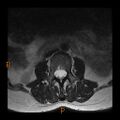 Normal spine MRI (Radiopaedia 77323-89408 Axial T2 3).jpg