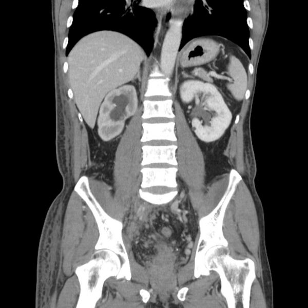File:Obstructive bladder transitional cell carcinoma (Radiopaedia 9825-10410 B 16).jpg