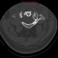 Occipital condyle fracture (Radiopaedia 18366-18208 Axial bone window 20).jpg