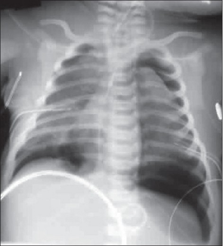 Bilateral pneumothorax seen in a newborn with meconium aspiration