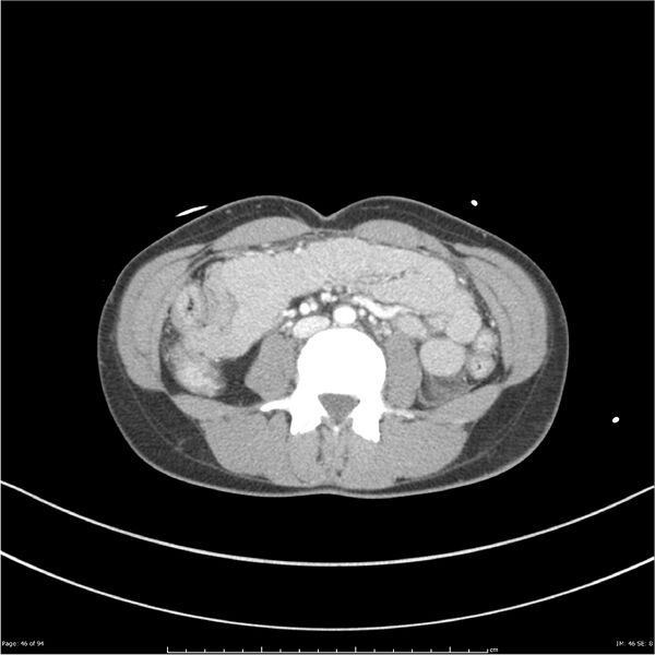 File:Traumatic renal artery dissection and pancreatic transection (Radiopaedia 37061-38739 Axial 211).jpg