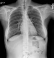 11 pairs of ribs and lumbosacral transitional vertebra (Radiopaedia 61880-69918 Frontal 1).jpg
