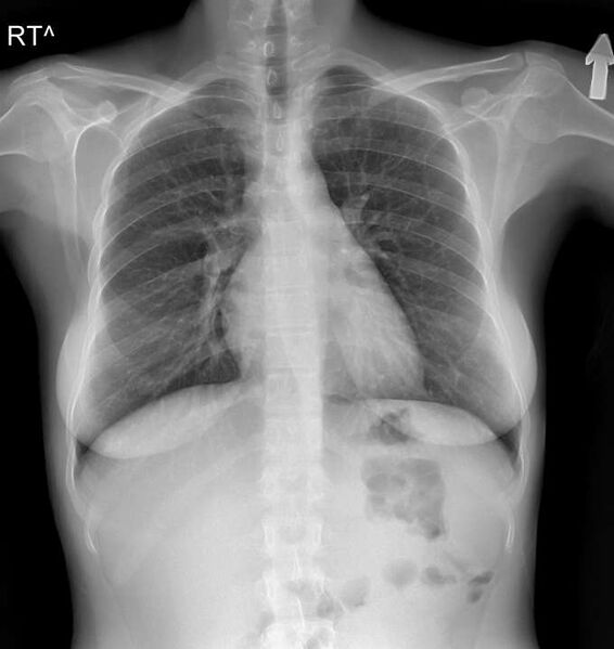 File:11 pairs of ribs and lumbosacral transitional vertebra (Radiopaedia 61880-69918 Frontal 1).jpg