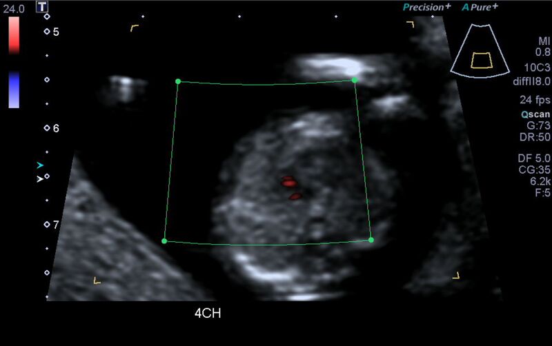 File:1st trimester nuchal-morphology ultrasound (Radiopaedia 44706-48477 Heart views cine with colour 3).jpg
