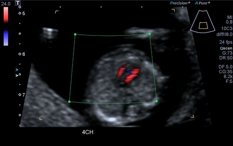 File:1st trimester nuchal-morphology ultrasound (Radiopaedia 44706-48477 Heart views cine with colour 72).jpg
