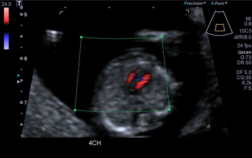 1st trimester nuchal-morphology ultrasound (Radiopaedia 44706-48477 Heart views cine with colour 72).jpg