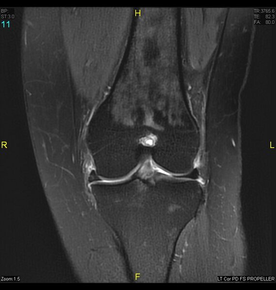 File:ACL mucoid degeration with cystic changes (Radiopaedia 48428-53341 Coronal PD fat sat 8).jpg