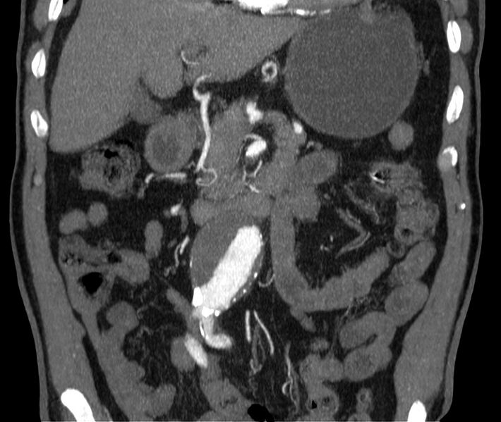 File:Abdominal aortic aneurysm (Radiopaedia 22421-22458 C 14).jpg