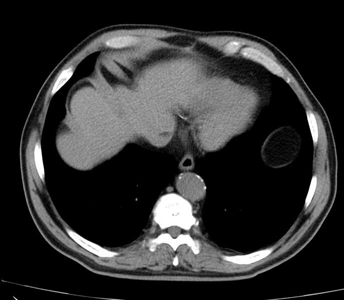 File:Abdominal aortic aneurysm (Radiopaedia 22421-22458 non-contrast 4).jpg