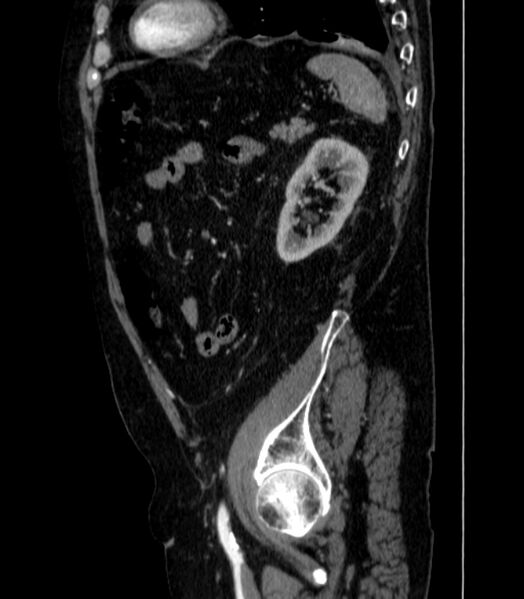 File:Abdominal aortic aneurysm (Radiopaedia 25855-26001 Sagittal C+ arterial phase 63).jpg
