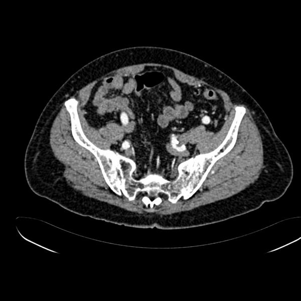 File:Abdominal aortic aneurysm (Radiopaedia 75131-86203 Axial C+ arterial phase 37).jpg