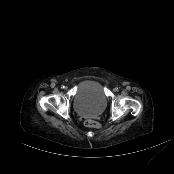 File:Abdominal aortic aneurysm - impending rupture (Radiopaedia 19233-19246 Axial non-contrast 121).jpg