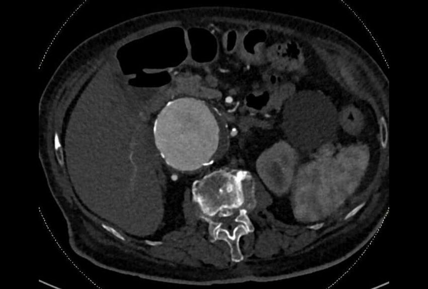 Abdominal aortic aneurysm with thrombus fissuration (Radiopaedia 73192-83919 Axial C+ arterial phase 51).jpg
