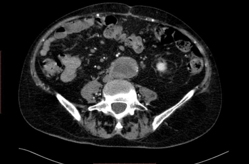 File:Abdominal aortic interposition tube graft and aneurysm thrombosis (Radiopaedia 71438-81857 Axial C+ arterial phase 117).jpg