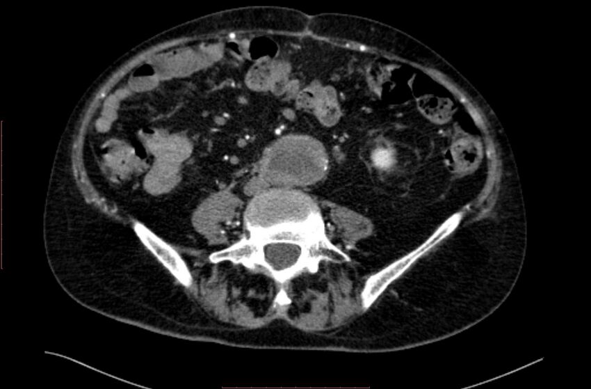 Abdominal aortic interposition tube graft and aneurysm thrombosis (Radiopaedia 71438-81857 Axial C+ arterial phase 117).jpg