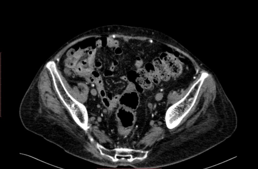 Abdominal aortic interposition tube graft and aneurysm thrombosis (Radiopaedia 71438-81857 Axial C+ arterial phase 187).jpg