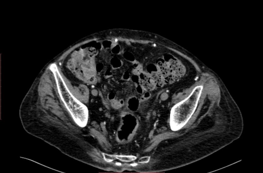 Abdominal aortic interposition tube graft and aneurysm thrombosis (Radiopaedia 71438-81857 Axial C+ arterial phase 193).jpg