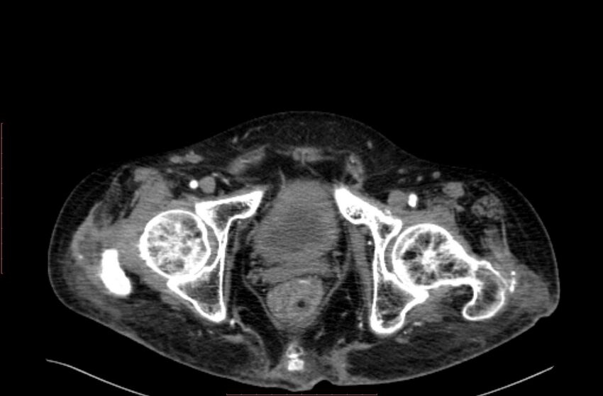 Abdominal aortic interposition tube graft and aneurysm thrombosis (Radiopaedia 71438-81857 Axial C+ arterial phase 237).jpg