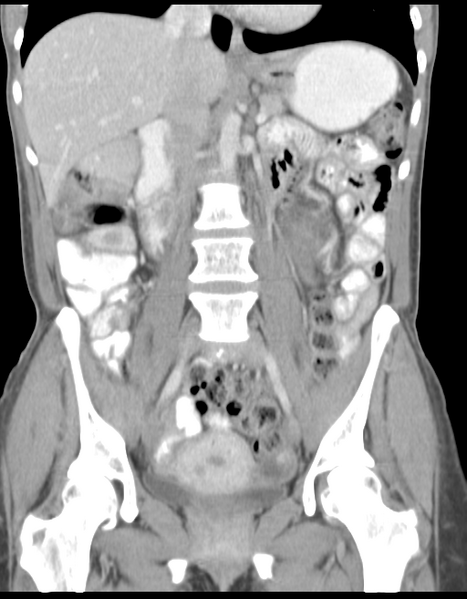 File:Abdominal desmoid tumor (Radiopaedia 41007-43740 Coronal C+ portal venous phase 21).png