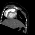 Aberrant left pulmonary artery (pulmonary sling) (Radiopaedia 42323-45435 Coronal C+ CTPA 20).jpg