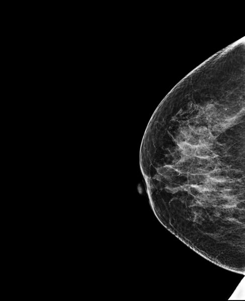 File:Accessory breast tissue (Radiopaedia 74571-85500 CC 1).jpg