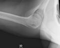 Acromioclavicular joint injury- grade 4 (Radiopaedia 49834-55104 Axillary view 1).jpg