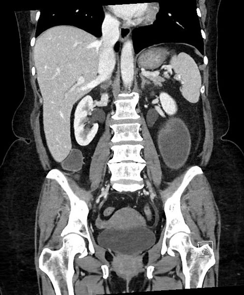 File:Active Crohn disease (Radiopaedia 59394-66750 Coronal C+ portal venous phase 43).jpg