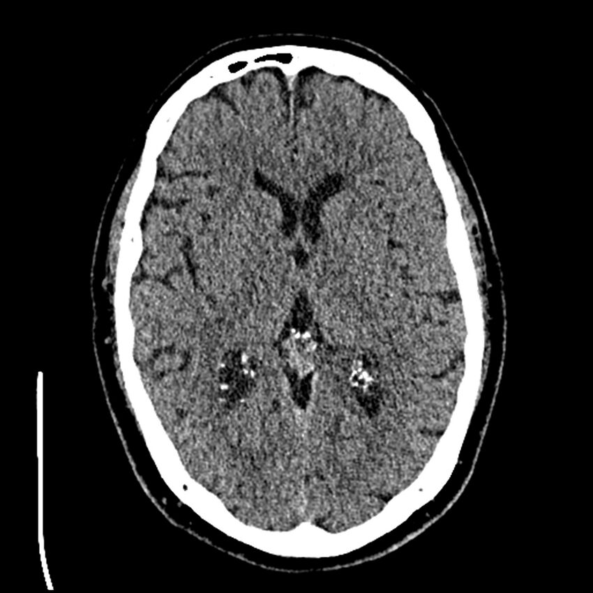 Acute A3 occlusion with ACA ischemic penumbra (CT perfusion) (Radiopaedia 72036-82525 Axial non-contrast thins 34).jpg