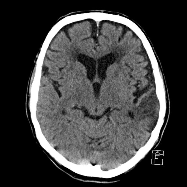 File:Acute P1 occlusion with PCA ischemia penumbra (CT perfusion) (Radiopaedia 72084-82586 Axial non-contrast 19).jpg