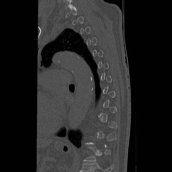 File:Acute and chronic vertebral compression fractures (Radiopaedia 31608-32494 Sagittal bone window 26).jpg