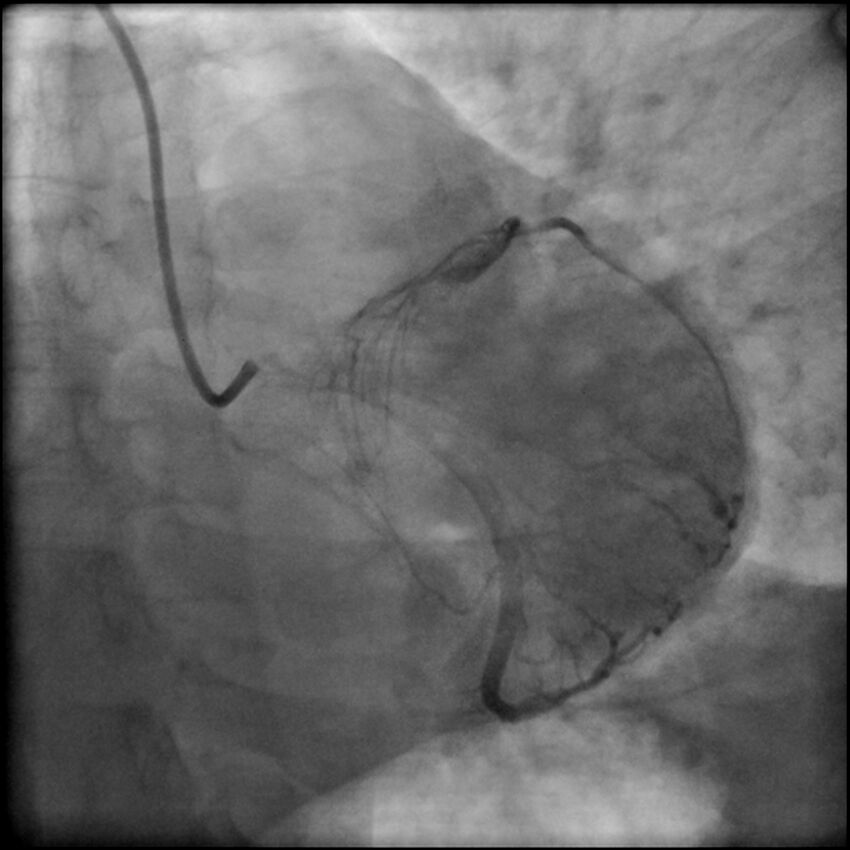 Acute anteroseptal myocardial infarction (Radiopaedia 68409-77946 LAO caudal (spider view) LAD and CX 55).jpg