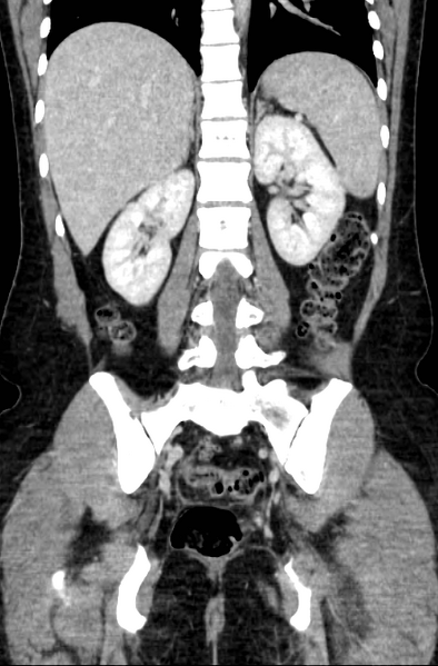 File:Acute appendicitis (Radiopaedia 22892-22918 Coronal C+ portal venous phase 38).png