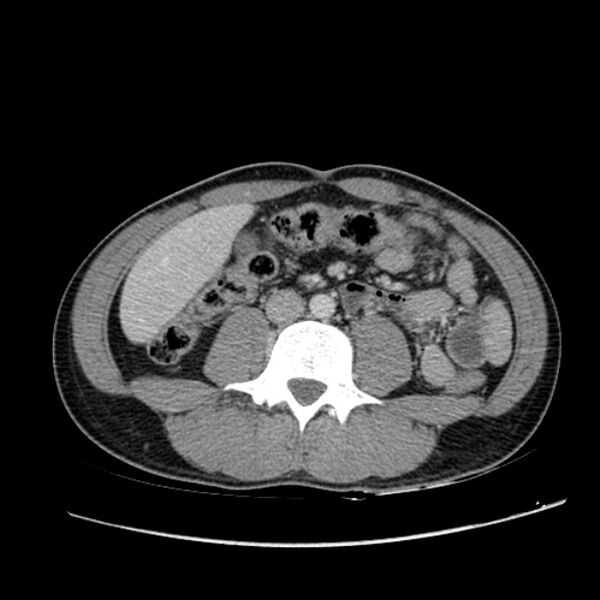 File:Acute appendicitis (Radiopaedia 27049-27227 Axial C+ portal venous phase 39).jpg